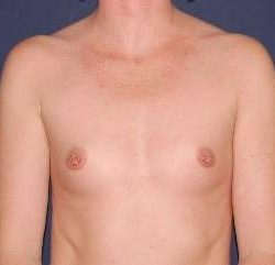 Breast Enlargement Before & After Patient #1130