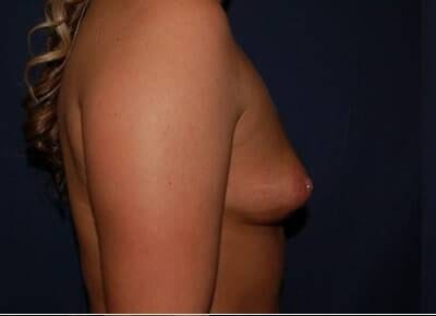 Breast Enlargement Before & After Patient #1134