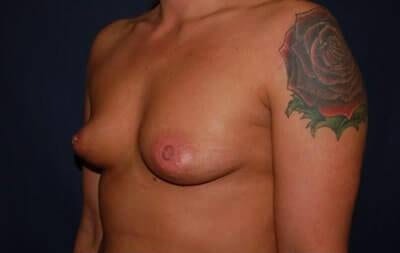 Breast Enlargement Before & After Patient #1134