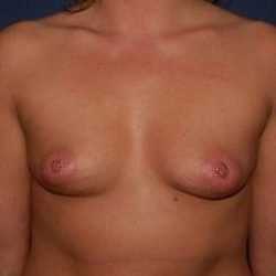 Breast Enlargement Before & After Patient #1134