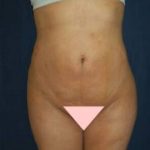 Brazilian Butt Lift Before & After Patient #1145