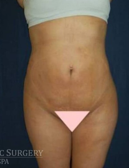 Brazilian Butt Lift Before & After Patient #1145