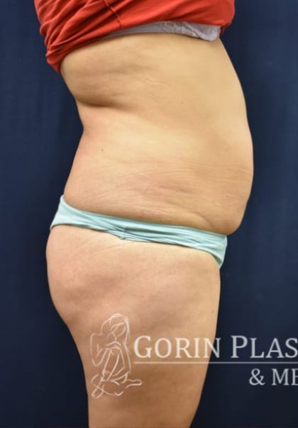 Brazilian Butt Lift Before & After Patient #1149
