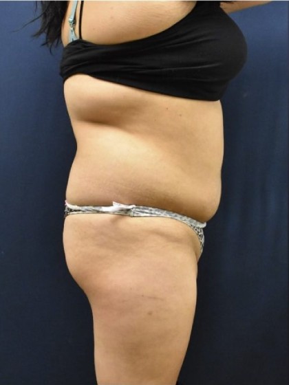 Brazilian Butt Lift Before & After Patient #1154