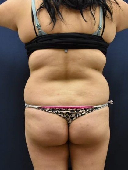 Brazilian Butt Lift Before & After Patient #1154