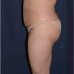 Brazilian Butt Lift Before & After Patient #1157