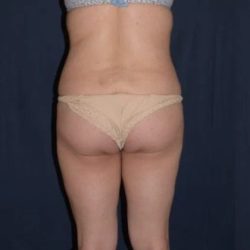 Brazilian Butt Lift Before & After Patient #1157
