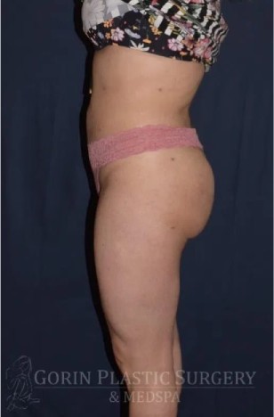 Brazilian Butt Lift Before & After Patient #1157