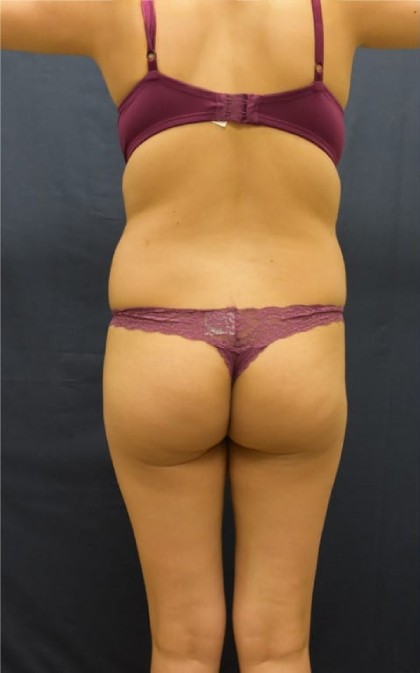 Brazilian Butt Lift Before & After Patient #1161