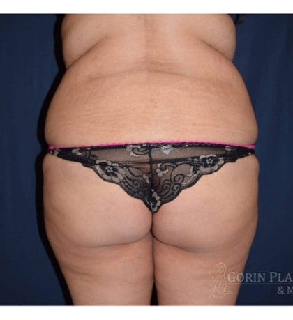 Brazilian Butt Lift Before & After Patient #1165