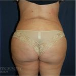 Brazilian Butt Lift Before & After Patient #1165