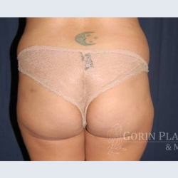 Brazilian Butt Lift Before & After Patient #1167