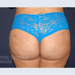 Brazilian Butt Lift Before & After Patient #1167