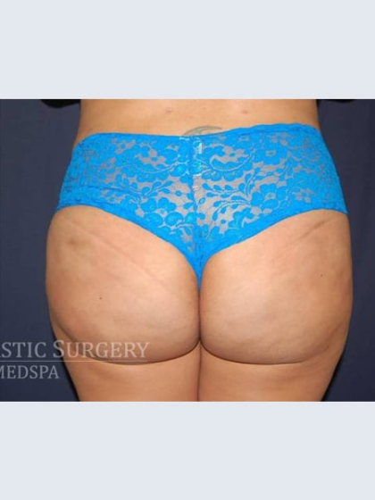 Brazilian Butt Lift Before & After Patient #1167