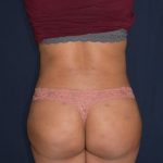 Brazilian Butt Lift Before & After Patient #1169