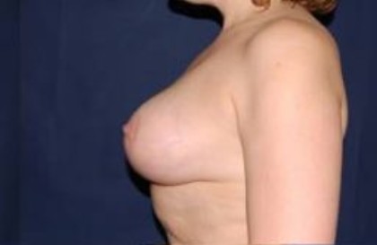 Breast Lift Without Implants Before & After Patient #1172