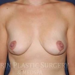 Breast Lift Without Implants Before & After Patient #1175