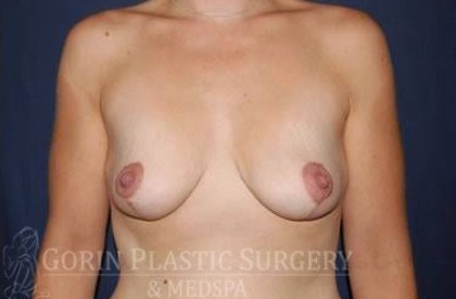 Breast Lift Without Implants Before & After Patient #1175