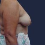 Breast Lift Without Implants Before & After Patient #1179