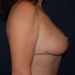 Breast Lift Without Implants Before & After Patient #1185