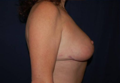 Breast Lift Without Implants Before & After Patient #1185