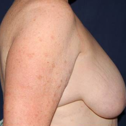Breast Lift Without Implants Before & After Patient #1188