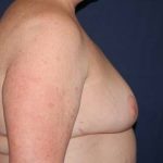 Breast Lift Without Implants Before & After Patient #1188