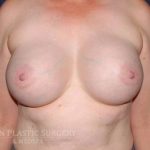 Secondary Breast Surgery Before & After Patient #1190