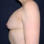 Secondary Breast Surgery Before & After Patient #1190