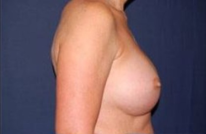 Secondary Breast Surgery Before & After Patient #1193