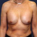 Secondary Breast Surgery Before & After Patient #1193