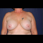 Secondary Breast Surgery Before & After Patient #1196