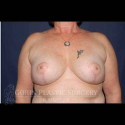 Secondary Breast Surgery Before & After Patient #1196