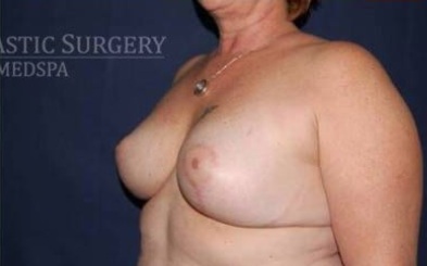 Secondary Breast Surgery Before & After Patient #1196