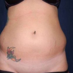 Liposuction Before & After Patient #1209