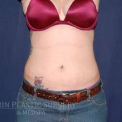 Liposuction Before & After Patient #1209