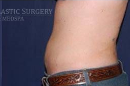 Liposuction Before & After Patient #1209