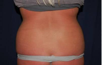Liposuction Before & After Patient #1213