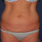 Liposuction Before & After Patient #1213