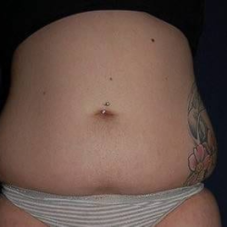 Liposuction Before & After Patient #1216