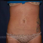 Liposuction Before & After Patient #1216