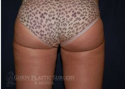 Liposuction Before & After Patient #1216