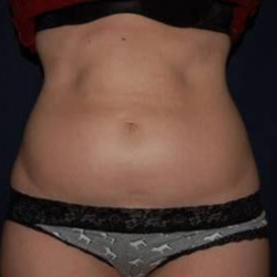 Liposuction Before & After Patient #1221