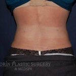 Liposuction Before & After Patient #1221
