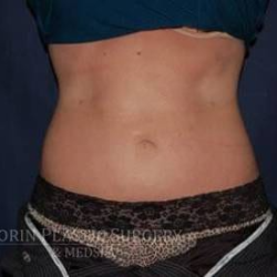 Liposuction Before & After Patient #1221
