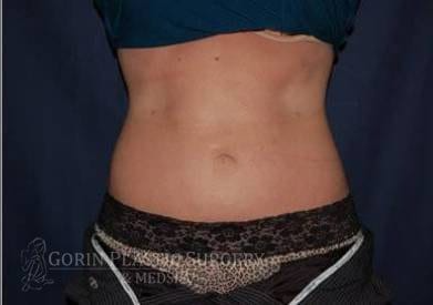 Liposuction Before & After Patient #1221