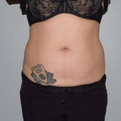 Liposuction Before & After Patient #1226