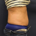 Liposuction Before & After Patient #1230