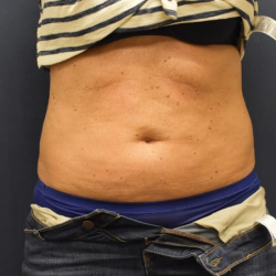 Liposuction Before & After Patient #1230