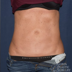 Liposuction Before & After Patient #1230